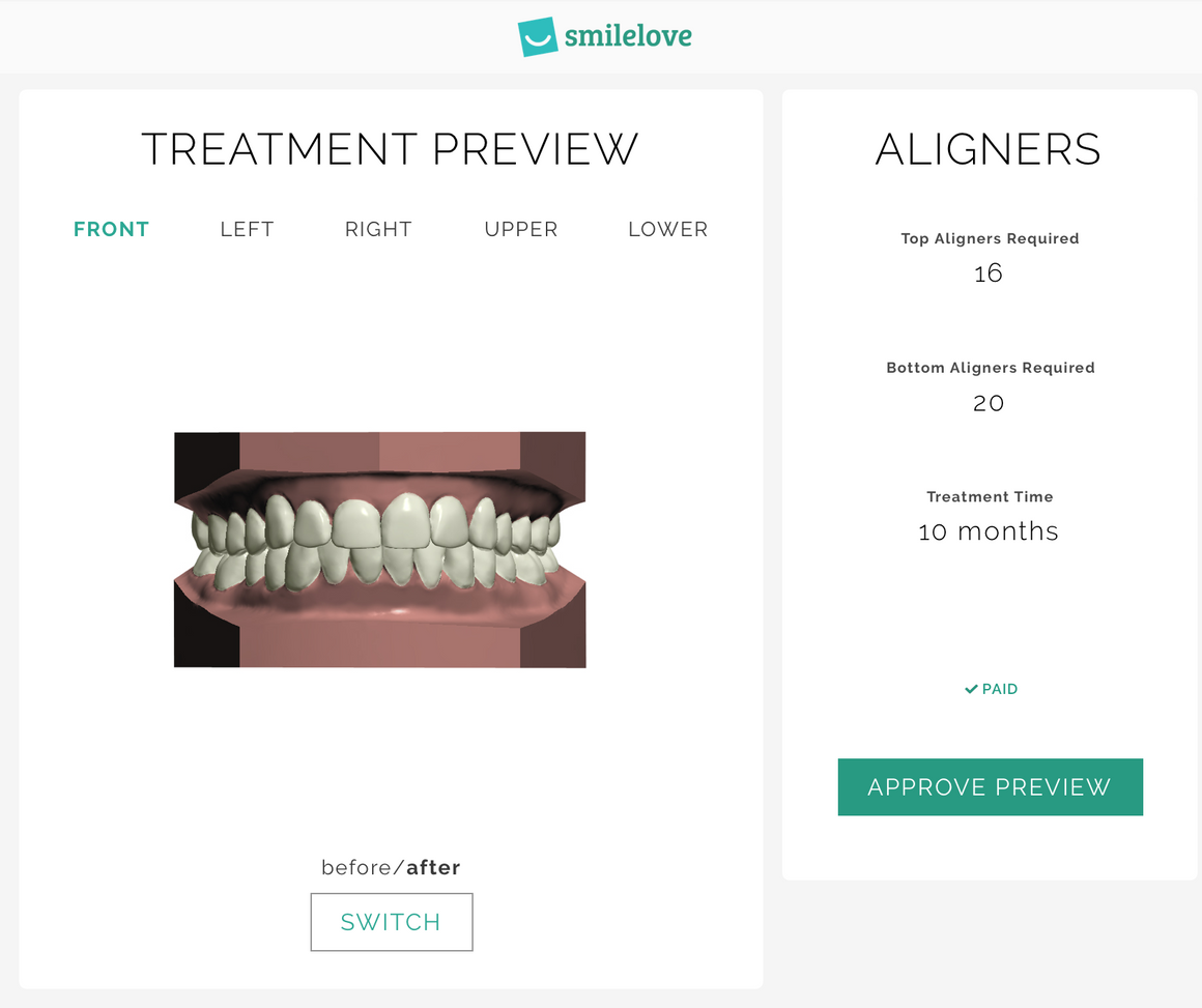 3D Treatment Preview | Smilelove Canada