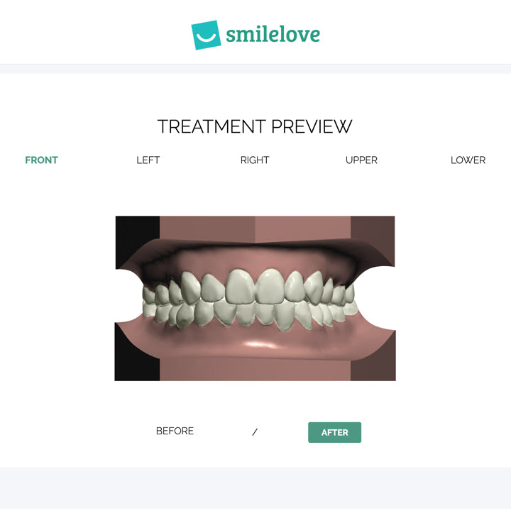 smilelove-braces-two