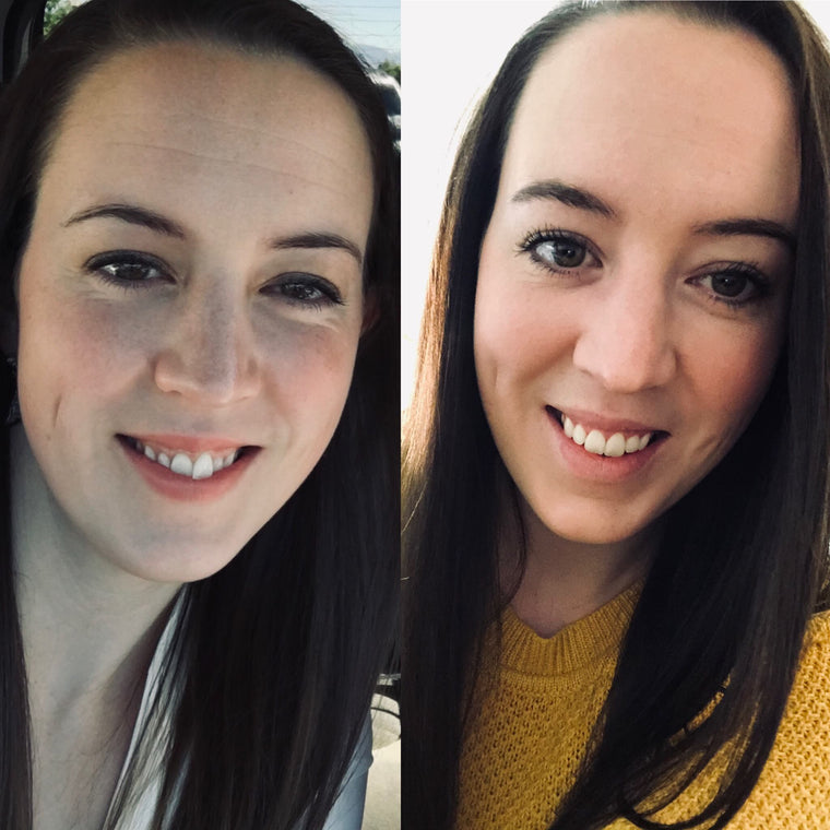 Before And After Review | Smilelove Canada